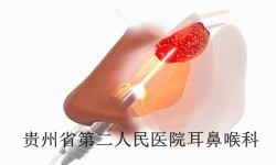 引起鼻窦炎的原因有哪些