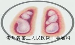 鼻甲肥大的病因是什么