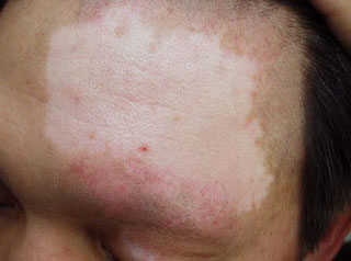 脸上长了白癜风有哪些要注意的