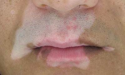 脸上长了白癜风要怎么治