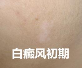 通过白癜风图片了解白癜风晚期症状