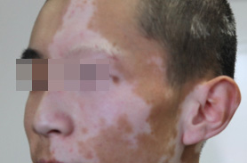 白癜风不治疗会怎么样