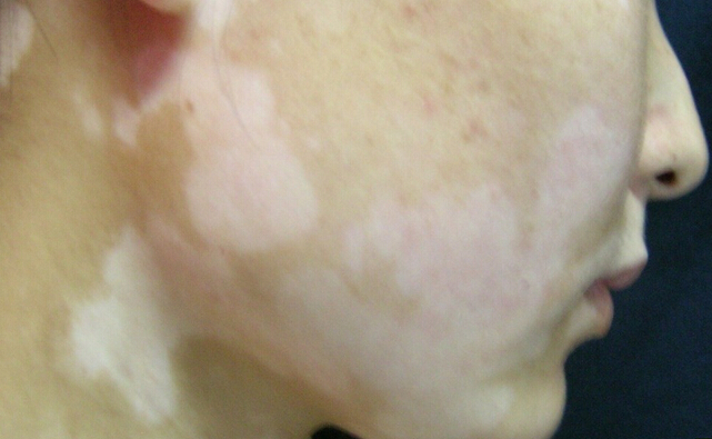 面部白斑的患者会怎样呢