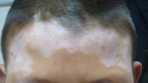 脸上白斑的病因会是什么