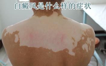 散发型的白癜风症状表现有什么