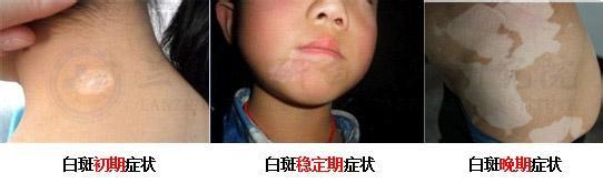 白癜风患者心声:一开始不以为意,到最后追悔莫及