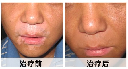 白癜风初发时为点状或片状色素减退斑