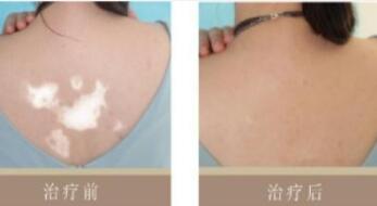 如何让白癜风在寒冬不再扩散!