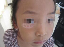 武汉小孩白癜风症状有哪些呢 武汉小孩白癜风症状有哪些呢