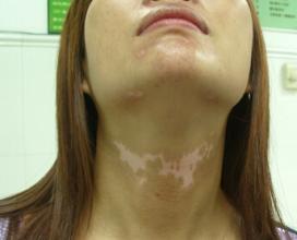 武汉女性有白癜风怎么治疗效果好 武汉女性有白癜风怎么治疗效果好