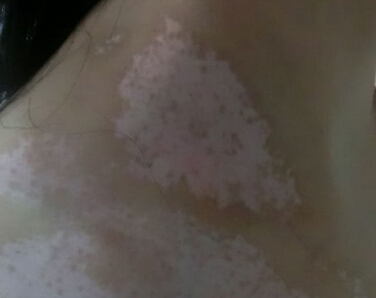 武汉学生白癜风多久可以康复 武汉学生白癜风多久可以康复