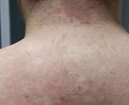 治疗白癜风使用什么方法 如何有效的治疗白癜风呢