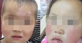 白癜风预防护理方法 夏季背部白癜风该怎样护理