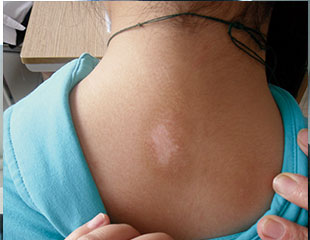 预防白癜风有哪些办法 患白癜风后怎样调理身体呢