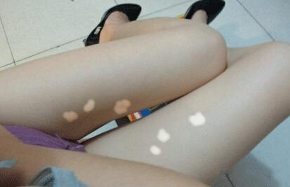 白癜风初期什么症状图片 女性泛发型白癜风症状