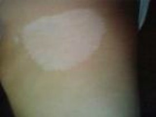 武汉生活中该怎样预防白癜风呢 武汉正确预防白癜风有哪些方法