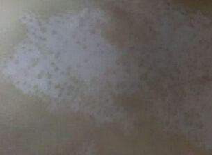 湖北白癜风医院解答白癜风初期症状特点是怎样的呢 武汉白斑医院解答白癜风的症状表现是怎样呢