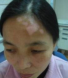 武汉白斑医院解答初发白癜风症状有哪些 武汉环亚医院分析白癜风初患症状有哪些