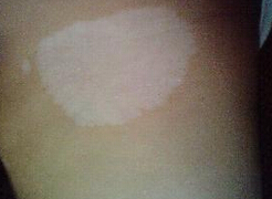 白癜风有哪些症状特征?武汉治疗白癜风医院哪家最好 如何正确区分白癜风与白斑?武汉治疗白癜风医院排名?