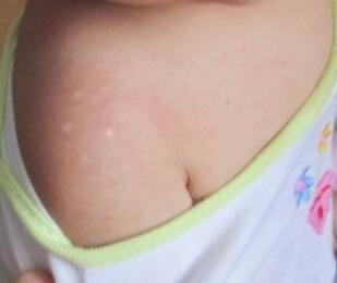 武汉哪家白癜风医院最好?女性患者如何护理白癜风 武汉有白癜风医院吗?怎样有效的预防白癜风的产生