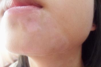 武汉治白癜风好不好?预防白癜风扩散有什么好方法? 治疗白癜风武汉哪个医院好?治疗白癜风扩散的处理方法是什么